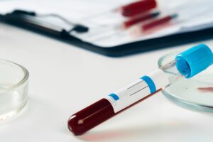 Blood test analysis with Petri dish close up